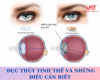  ĐỤC THỦY TINH THỂ VÀ NHỮNG ĐIỀU CẦN BIẾT